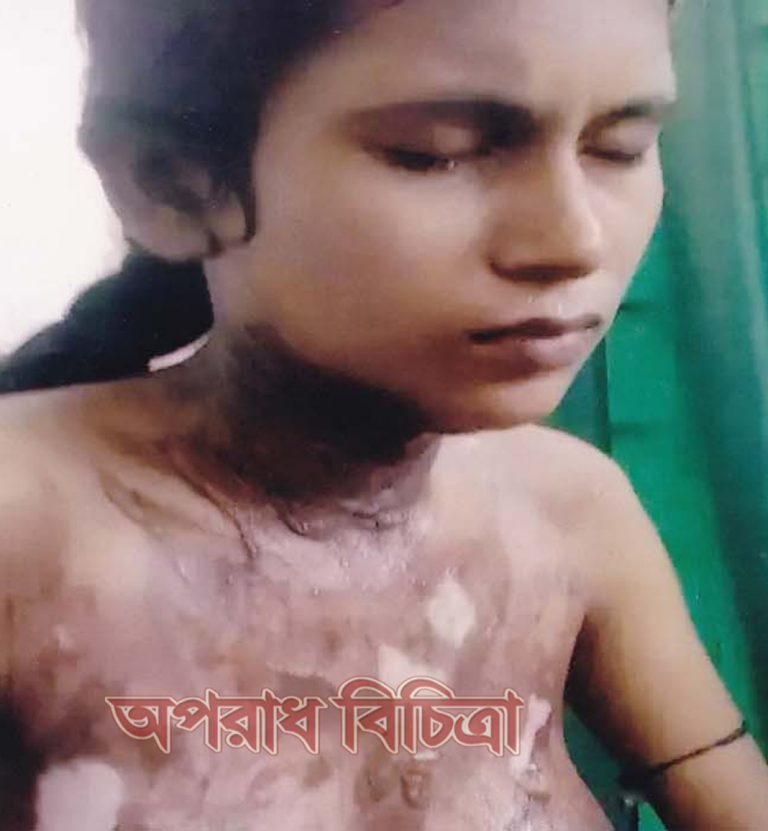 সুধারামে যৌতুকের ২ লাখ টাকা আদায়ে ব্যর্থ হয়ে ৪ মাসের অন্তসত্তা গৃহবধূকে পুড়িয়ে হত্যার চেষ্টা