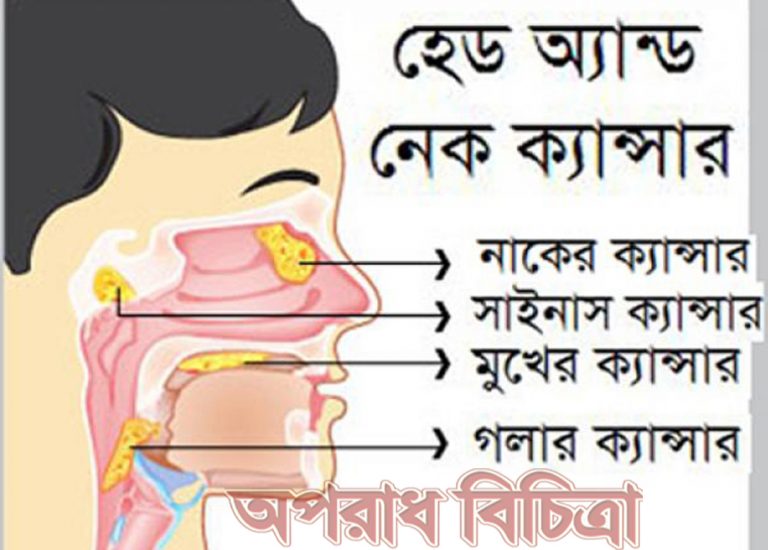 দেশে হেড-নেক ক্যান্সারে আক্রান্ত রোগীদের পরিসংখ্যান নেই