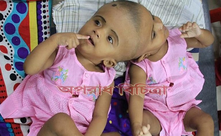 জোড়া মাথার শিশু রাবেয়া ও রোকাইয়ার খোঁজ নিলেন প্রধানমন্ত্রী