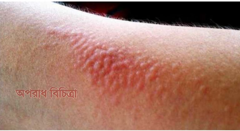 জেনে নিন বিনা পয়সায় এলার্জি নিরাময়ের উপায়
