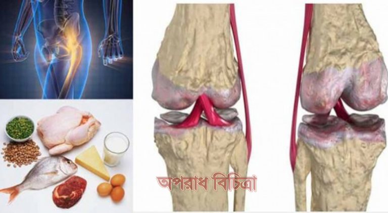শরীরে ক্যালসিয়ামের অভাবে যে সব রোগ দেখা দেয়