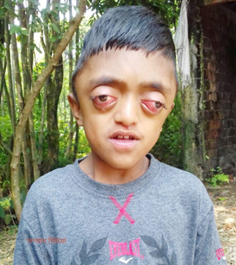 সেই চোখ ধীরে ধীরে নষ্ট হচ্ছে চিকিৎসার অভাবে