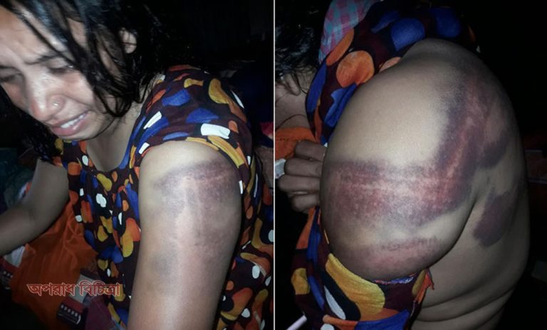 যৌতুকের কারণে শিক্ষক স্বামীর হাতে পাশবিক নির্যাতনের শিকার শিক্ষিকা স্ত্রী