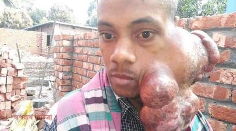 মুখে ৫ কেজি ওজনের ভার নিয়ে চলেছে অসহায় জীবন