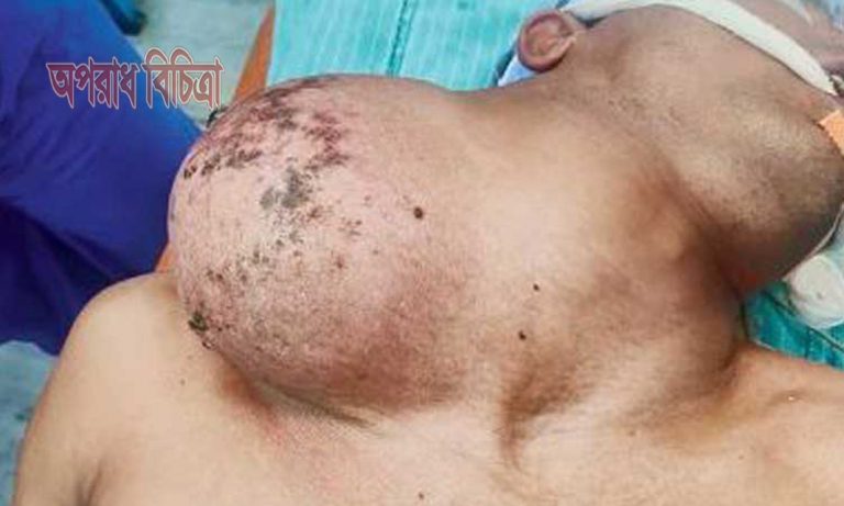গলায় বাসা বেঁধে ছিল ১০ কেজি ওজনের টিউমার