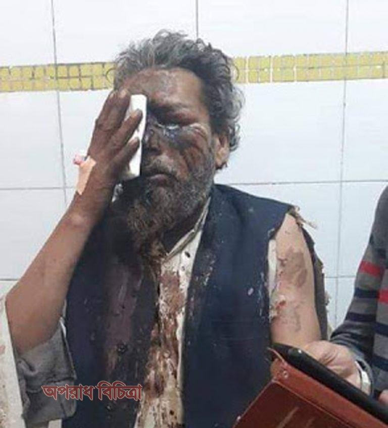 এসিড ঢেলে অন্ধ করা হয়েছে অনেক মুসলিমকে