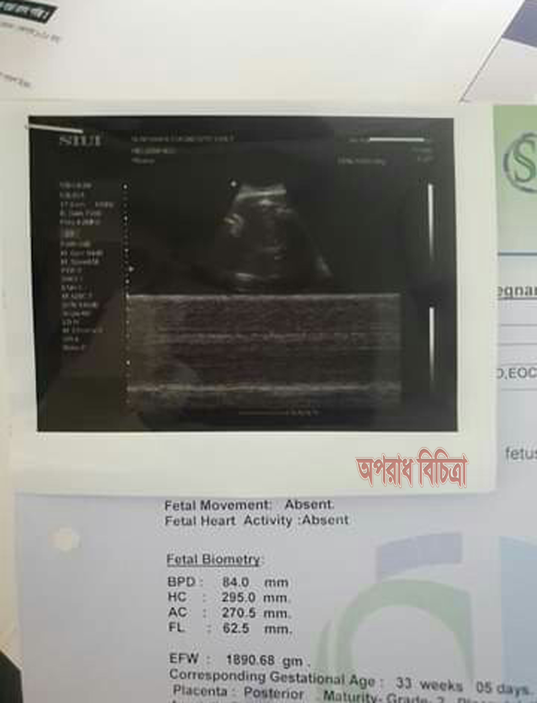 ঠাকুরগায়ে ডাক্তার রিপোর্ট দিলেন গর্ভের বাচ্চা মৃত, কিন্তু জন্ম নিলো জীবিত