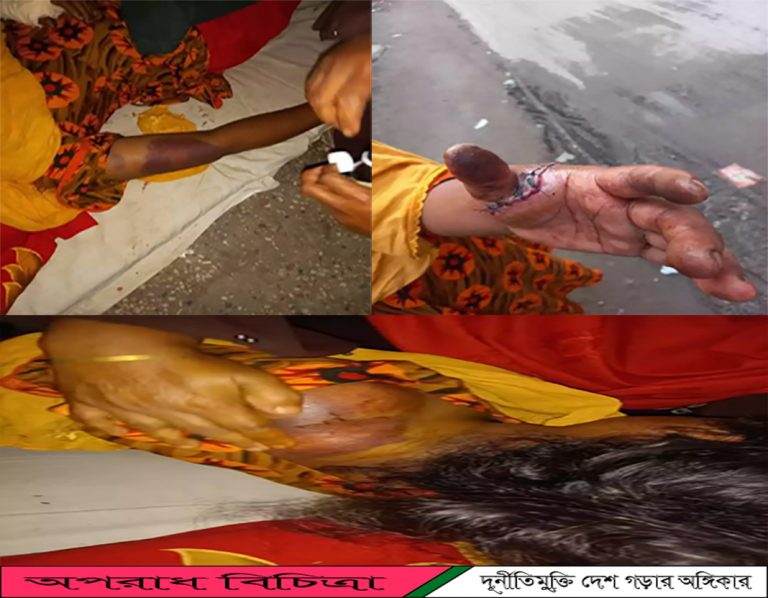 কিশোরগঞ্জে শশুড় কতৃক লোমহর্ষক নির্যাতনের স্বীকার শাহানা আক্তার