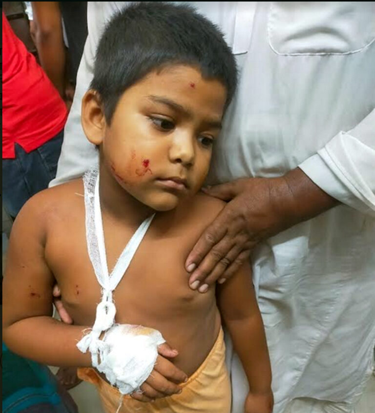শার্শায় কুড়িয়ে পাওয়া ককটেল বিস্ফোরণে দুই শিশু আহত
